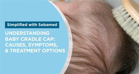 cradle cap in the elderly|Treating Cradle Cap in Adults .